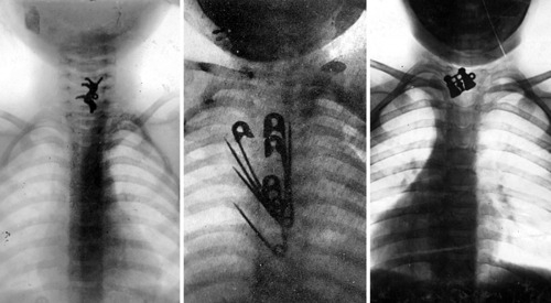 dr. Chevalier Jackson minden lenyelt, később kioperált tárgyat megőrzöt dr. Chevalier Jackson minden lenyelt, később kioperált tárgyat megőrzött