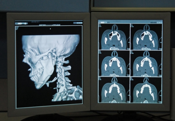 PET-CT-vizsgálat a korai kezdetű Alzheimer-kórban PET-CT-vizsgálat a korai kezdetű Alzheimer-kórban